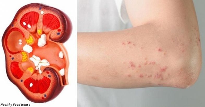 თირკმლის პრობლემების 10 ჩუმი სიმპტომი, რომლის იგნორირებაც არ ღირს. დააკვირდით კარგად.